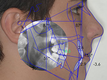 Estudios Cefalométricos Computarizados 2D y 3D